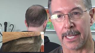 How to conceal FUT scars with FUE Dr Lindsey explains and interviews repair patient in DC  VA [upl. by Varien]