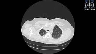 SCANNER THORACIQUE  Pleurésie bilatérale déjà traité pour TBK pulmonaire [upl. by Dusen]