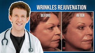 RESET Wrinkles Rejuvenation with Dr Adam Scheiner  Marilyns Testimonial [upl. by Ragse]