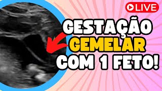 GESTAÇÃO GEMELAR COM 1 FETO [upl. by Reivilo479]