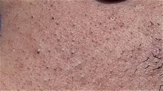 BLACKHEADS EXTRACTIONS on Happy 26 [upl. by Ias138]