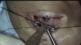 Posterior approach ConjunctivalMullers resection ptosis surgery Putterman procedure [upl. by Hildie239]