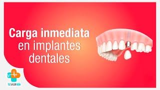 Carga inmediata en implantes dentales  Tu Salud Guía [upl. by Schmeltzer]