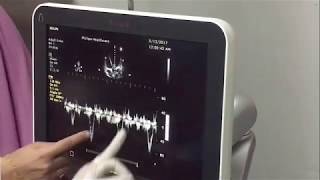 amazing LVOT VTI measurement live [upl. by Magel]