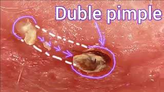 Squeezing out a mutant pimple Squeezing out pimples under a microscope Acne [upl. by Gyimah]