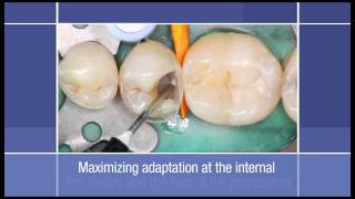 Posterior Restoration How to use a Flowable Restorative as a Liner in a Class II Dental Restoration [upl. by Glinys]