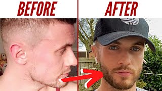 My 2 Year Minoxidil Beard Transformation [upl. by Cirri]