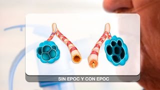 EPOC qué es y su tratamiento [upl. by Yolanthe]