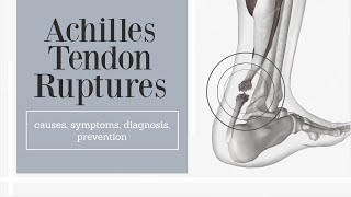 Achilles tendon rupture causes symptoms diagnosis and prevention [upl. by Jac192]