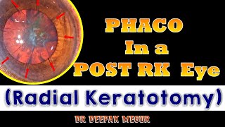 Phacoemulsification in a Post RK eye  Radial Keratotomy  Understanding the Strategies [upl. by Basile]