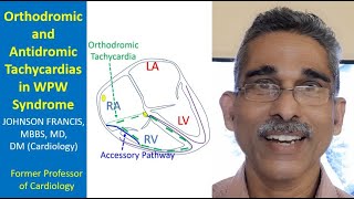 Orthodromic and Antidromic Tachycardias in WPW Syndrome [upl. by Ytsur]