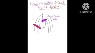 Conus medullaris vs Cauda Equina Syndrome orthopedicsspinalcordinjurymbbsneetpg inicetfmge [upl. by Leynwad181]