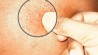 ASMR Back nitpicking blackheads  put to sleep in 3 minutes [upl. by Oneil588]