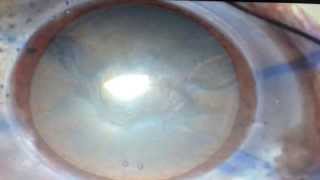 Pkp with cataract extraction with IOL [upl. by Ahseikan]