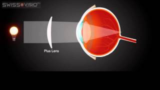 Inside the Eye Farsightedness Hyperopia [upl. by Elie]