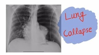 Chest X Ray Lung Collapse collapse consolidation chestxray imaging radiology [upl. by Giannini634]