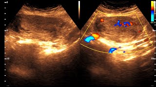 Partial Molar Pregnancy  GESTATIONAL TROPHOBLASTIC  Hydatidiform Molar Pregnancy NEOPLASIA [upl. by Ahsiuqal]