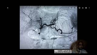 Treating GI bleeding with EMBOLIZATION [upl. by Arnoldo852]