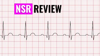 EKG NURSING QUICK REVIEW [upl. by Yatnoj88]