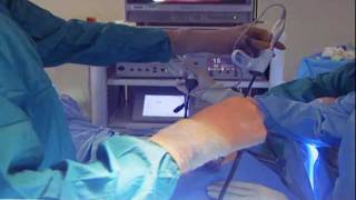 Laparoscopic Hysterectomy [upl. by Westphal]