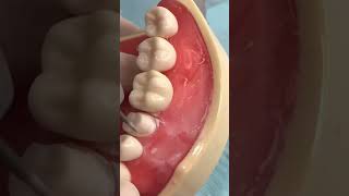 Tooth prep for a lower premolar crown dentalshorts dentalcrowns dentaleducation [upl. by Marquardt]