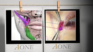 How to perform Smile Lipt Mouth corner lifting procedure and its effectiveness [upl. by Coughlin]