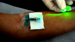 Intravenöse Laserblutbestrahlung mit dem Weberneedle® Endo Laser [upl. by Adiaroz]