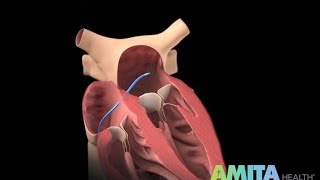 What Is Catheter Ablation — AMITA Health [upl. by Rasecoiluj976]