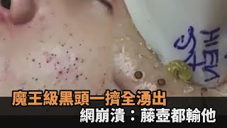 密集恐懼慎入！男子臉頰長滿黑頭粉刺 美容師一擠「啵啵啵」全湧出－全民話燒 [upl. by Isador]