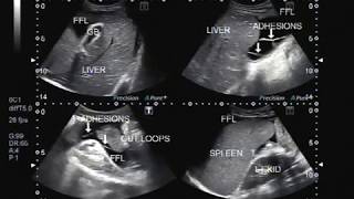 Ultrasound Video showing multiple findings in a patient suffering from Viral hepatitis [upl. by Hannej]