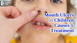 Mouth Ulcers in Children  MOUTH ULCER Treatment amp Causes  Dr K Saranya  Doctors Circle [upl. by Ennire]