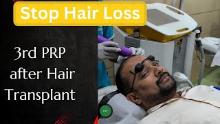 3rd PRP after Hair Transplant [upl. by Aizat]