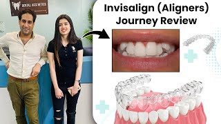 Invisalign Aligners Journey Before and After Review  Invisible Braces  Dental Aesthetics [upl. by Angelita703]