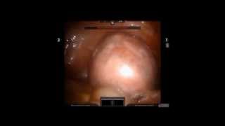 simple myomectomy using the robot [upl. by Vogele]