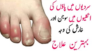 Hath Or Paon Ki Ungliyon Ki Sojan Ka Ilaj  Fingers Swelling In Winter  Remedy Clinic [upl. by Marja]