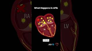 Process of AFib in Your Heart [upl. by Godfree]