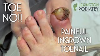 TOE NO Painful Ingrown Toenail Removal [upl. by Amando]