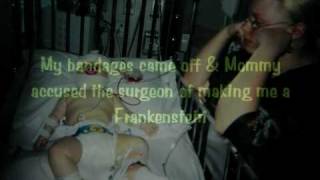 A Craniosynostosis Journey [upl. by Newcomb]