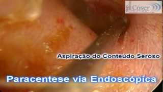 Paracentese Timpânica Endoscópica 2Tympanic Paracentesis Otoendoscopic technique 2 [upl. by Eilac191]