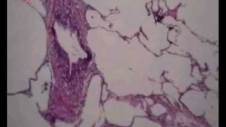 HistoPathology Emphysema د عبد الرحمن خليفة [upl. by Irap]