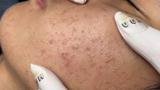 ACNE TREATMENT VU QUYNH MI Acne On Teens Cheek 2024 [upl. by Conard]