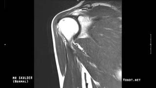 MR undersøkelse av skulder Normal [upl. by Oterol]