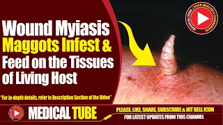 Wound Myiasis  Causes Symptoms Diagnosis And Treatment  Medical Tube [upl. by Enilada]