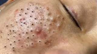 Big Cystic Acne Blackheads Extraction Blackheads amp Milia Whiteheads Removal Pimple Popping  3899 [upl. by Latini673]