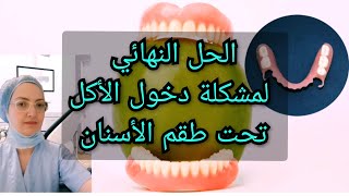 الحل النهائي لمشكلة دخول الأكل تحت طقم الأسنان المتحرك الكامل و الجزئي Prothèse dentaire amovible [upl. by Pennie]