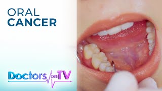 Oral Cancer Prevention amp Treatment  Doctors on TV [upl. by Yrakaz614]