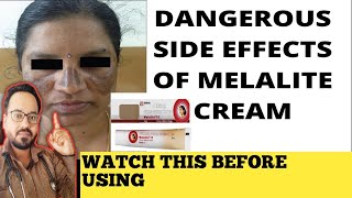 Melalite Cream Review  इस क्रीम का इस्तेमाल ना करें [upl. by Bovill]