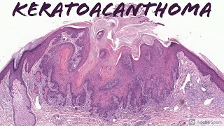 Keratoacanthoma 5Minute Pathology Pearls [upl. by Knitter]