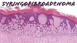 Eccrine Syringofibroadenoma  rare skin adnexal tumorpattern dermpath dermatology pathology [upl. by Neelak]