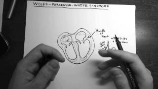 WolffParkinsonWhite Syndrome [upl. by Aterg]